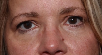 Lower Blepharoplasty Before & After Patient #33418