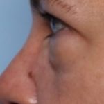 Lower Blepharoplasty Before & After Patient #33418