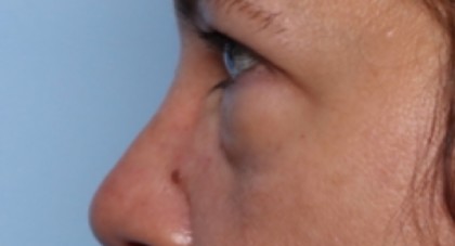 Lower Blepharoplasty Before & After Patient #33418