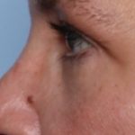 Lower Blepharoplasty Before & After Patient #33418