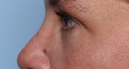 Lower Blepharoplasty Before & After Patient #33418