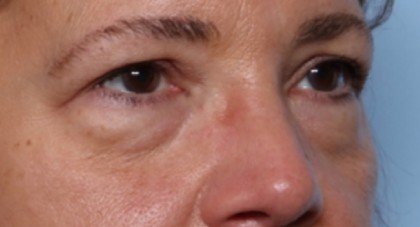 Lower Blepharoplasty Before & After Patient #33418