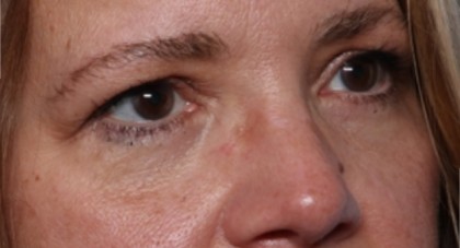 Lower Blepharoplasty Before & After Patient #33418