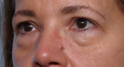 Lower Blepharoplasty Before & After Patient #33418