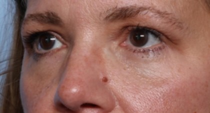 Lower Blepharoplasty Before & After Patient #33418