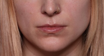 Lip Filler Before & After Patient #33399