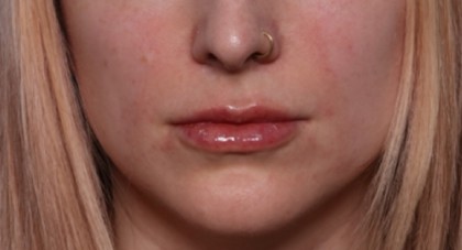 Lip Filler Before & After Patient #33399