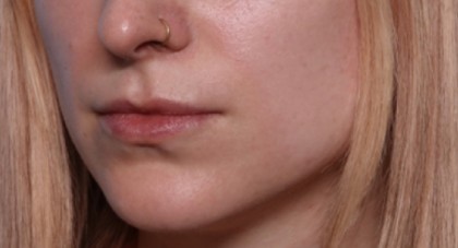 Lip Filler Before & After Patient #33399