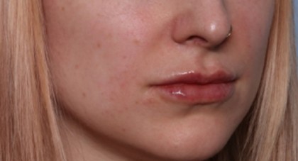 Lip Filler Before & After Patient #33399