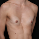 Breast Augmentation Before & After Patient #33427