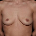 Breast Augmentation Before & After Patient #33491