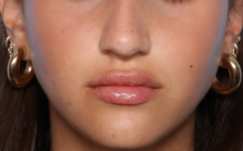 Lip Filler Before & After Patient #33444