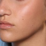 Lip Filler Before & After Patient #33444