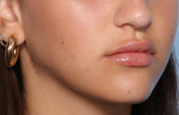 Lip Filler Before & After Patient #33444