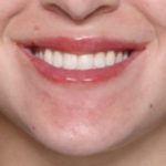 Lip Filler Before & After Patient #33503