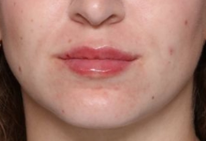 Lip Filler Before & After Patient #33503