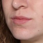 Lip Filler Before & After Patient #33503