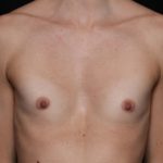 Breast Augmentation Before & After Patient #33427