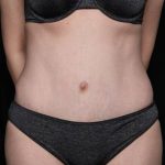 Tummy Tuck Before & After Patient #33480