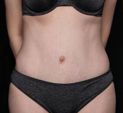 Tummy Tuck Before & After Patient #33480