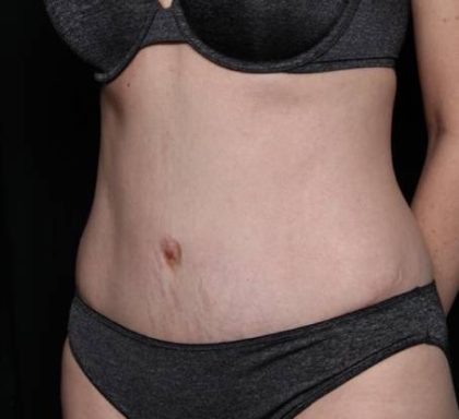 Tummy Tuck Before & After Patient #33480