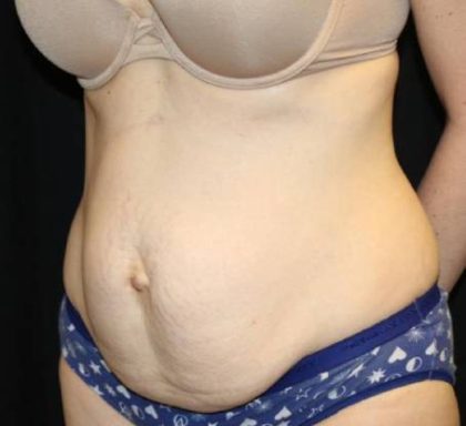 Tummy Tuck Before & After Patient #33480