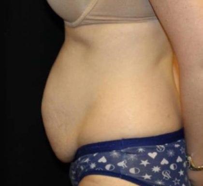 Tummy Tuck Before & After Patient #33480