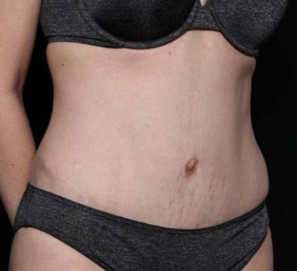 Tummy Tuck Before & After Patient #33480
