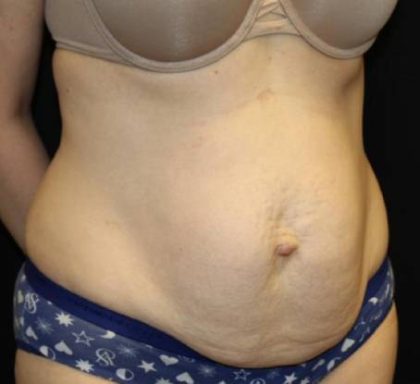 Tummy Tuck Before & After Patient #33480