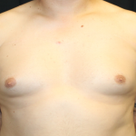 Gynecomastia Before & After Patient #33524