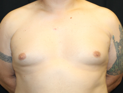 Gynecomastia Before & After Patient #33524