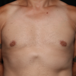 Gynecomastia Before & After Patient #33524