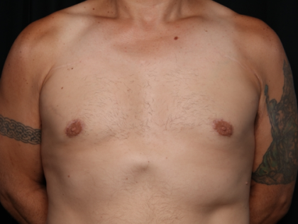 Gynecomastia Before & After Patient #33524