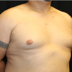 Gynecomastia Before & After Patient #33524