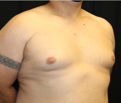 Gynecomastia Before & After Patient #33524