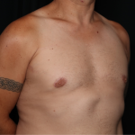 Gynecomastia Before & After Patient #33524