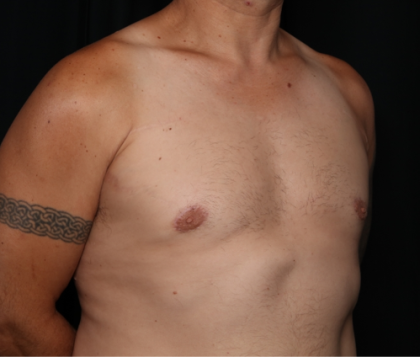 Gynecomastia Before & After Patient #33524