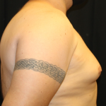 Gynecomastia Before & After Patient #33524