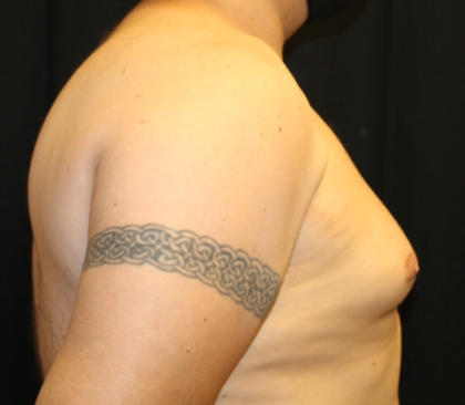 Gynecomastia Before & After Patient #33524