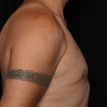 Gynecomastia Before & After Patient #33524