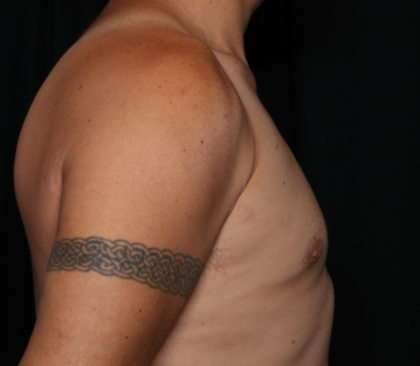 Gynecomastia Before & After Patient #33524