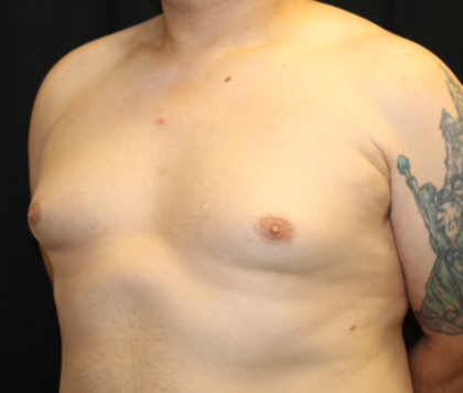 Gynecomastia Before & After Patient #33524