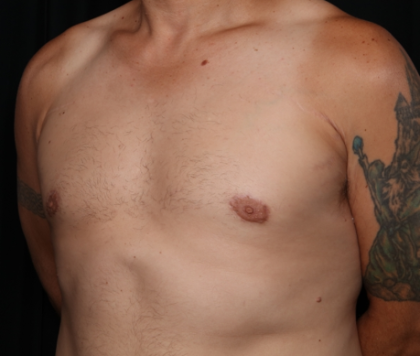 Gynecomastia Before & After Patient #33524