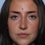 Rhinoplasty Before & After Patient #33510