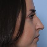 Rhinoplasty Before & After Patient #33510