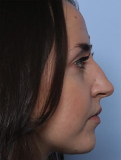 Rhinoplasty Before & After Patient #33510