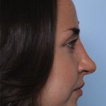 Rhinoplasty Before & After Patient #33510