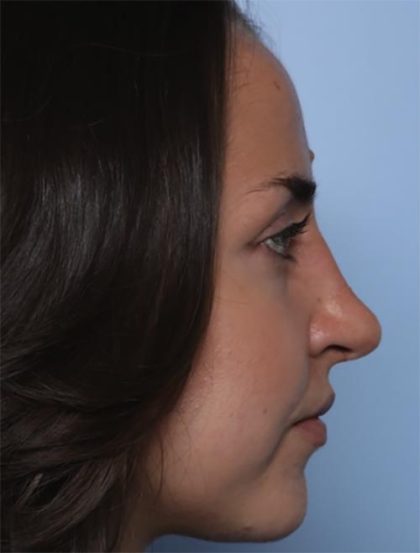 Rhinoplasty Before & After Patient #33510
