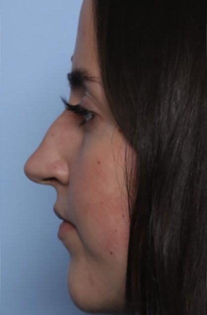 Rhinoplasty Before & After Patient #33510