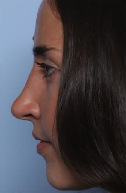 Rhinoplasty Before & After Patient #33510